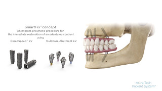 SmartFix® concept for Astra Tech Implant System® EV Stepbystep procedure [upl. by Verdie]