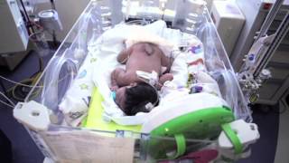 Newborn Baby with Spina Bifida Undergoes Multiple Surgeries [upl. by Nima]