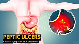 Peptic Ulcer Disease  पेप्टिक अल्सर रोग  Types  Causes  Pathophysiology  Hindi  Urdu [upl. by Anyr]