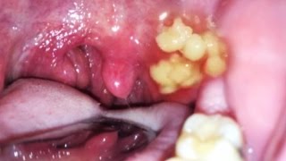 My Wifes Awful Tonsil Stones 2017 With Commentary [upl. by Aliam867]