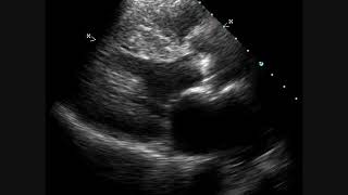 Calcific Aortic Stenosis  Echocardiogram [upl. by Iatnahs]