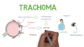 Trachoma  a devastating infectious eye disease [upl. by Niamart]