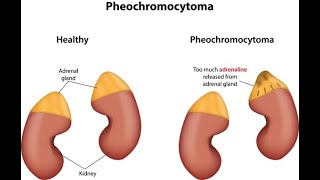 Pheochromocytoma  Simply Explained [upl. by Mahtal]