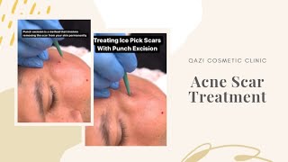 Treating Acne Scars With Punch Excision [upl. by Retsila]