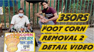 Foot corn removal complete detail videostep by step PART 2  Byculla Mumbai [upl. by Dragde]