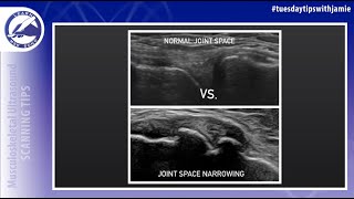 Ultrasound appearance of joint Space narrowing on MSK Ultrasound [upl. by Nodle]