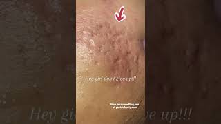 Effective method for removing deep acne scars [upl. by Akieluz]