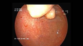 कोलोनोस्कोपी करने पर मिला बड़ी आंत में गांठ  Colonic polypoidal lesion at cecum  GASTROLIVER [upl. by Aehcsrop]