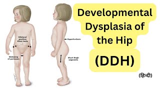 Developmental dysplasia of the hip DDH congenital hip dislocation in hindi [upl. by Frieder847]