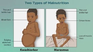 Protein Energy Malnutrition  Kwashiorkor amp Marasmus  Nutritional Disorder  digestion amp absorption [upl. by Olonam]