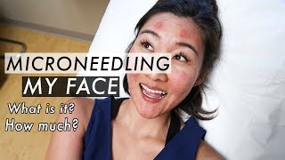 Microneedling Treatment Before and After  Acne Scar Removal [upl. by Mareld]