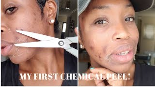 MY FIRST CHEMICAL PEEL  NO MORE ACNE BRIGHT GLOWY SKIN IN 1 WEEK [upl. by Kcirderf101]