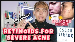 RETINOIDS BEST FOR ANTIACNE  MINIMIZE PORE  ANTIAGING  MY TRETINOIN JOURNEY BEFORE AND AFTER [upl. by Acinhoj111]