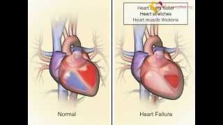 CVS  Decompensated heart failure [upl. by Adaliah]