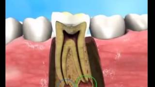 Treatment for Periapical abscess [upl. by Idarb]