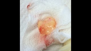 Cyst explodes [upl. by Janna]