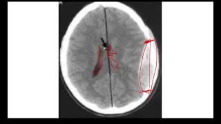 Serie de Casos Hematoma Epidural vs Subdural Tomografía Computarizada Hemorragía Intracraneal [upl. by Garvin821]