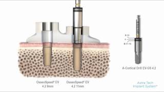 Astra Tech Implant System™ EV Guided surgery – cortical drilling with tube  Dentsply Sirona [upl. by Ttereve]