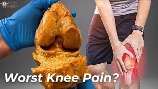 How Arthritis Destroys Your Knees [upl. by Snapp]