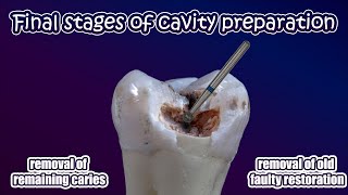 OperativePrinciples of Cavity Preparation7 [upl. by Lang]