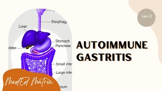 Autoimmune gastritis  Pathogenesis  Morphology  Clinical features [upl. by Kcinemod]