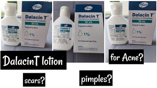 Dalacin T lotion Review Acne pimples ampscars [upl. by Atidnan]