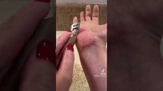 Shaving my nondominant hand  epidermolytic palmoplantar keratoderma  Feb 26 2023 [upl. by Alicul]