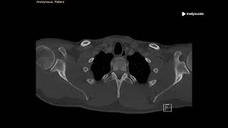 Mediastinal Emphysema  Pneumomediastinum  MedYouCate [upl. by Jaynell]