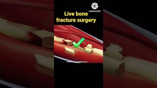 Live bone surgery treatment asmranimation animation shorts [upl. by Hartman]