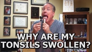 Natural Solutions For Swollen Tonsils How To Avoid A Tonsillectomy Common Sense Medicine [upl. by Ahsirhcal]