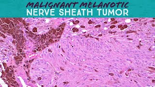 quotMelanotic Schwannomaquot malignant melanotic nerve sheath tumor pathology sarcoma Carney syndrome [upl. by Aerdnaeel]