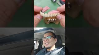 GIGI TIRUAN OVER TELESCOPIC DENTURE [upl. by Latimore644]