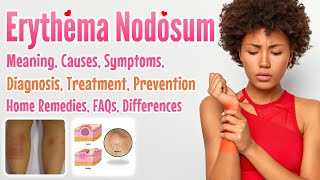 Erythema Nodosum meaning causes symptoms diagnosis treatment prevention home remedies FAQs [upl. by Rouvin]