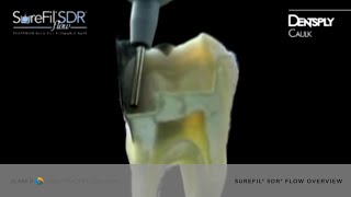 Watch the Revolutionary SureFil® SDR® flow Flowable Composite in Action  Dentsply Sirona [upl. by Eelac]