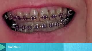 Braces Timelapse photos Misaligned Jaw TMJ [upl. by Enelyk]