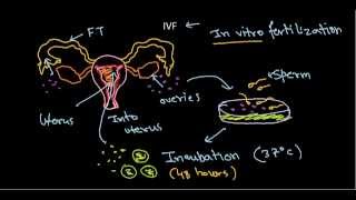 In vitro fertilization and embryo transfer IVF procedure [upl. by Eneli]