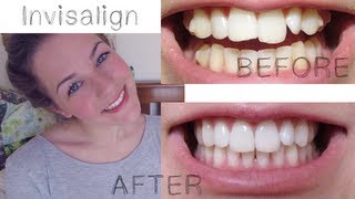 My Invisalign Treatment [upl. by Elleval]