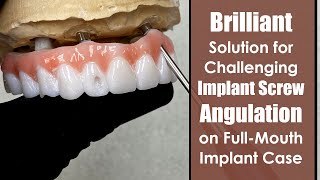 Brilliant Solution for Challenging Implant Screw Angulation on a FullMouth Zirconia Case [upl. by Arreic]