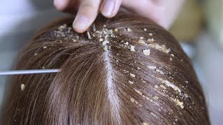 Dandruff Removal with Herbal Materials  Satisfying ASMR [upl. by Haroun]