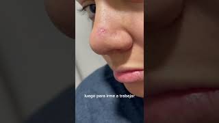 Parches para acné acne skincare tipsdeskincare [upl. by Nybbor]