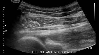 Shoulder Ultrasound Status Post Hydrodilation of Adhesive Capsulitis Part 2 [upl. by Nicola]