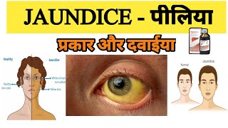 Jaundice treatment  Types of Jaundice  Symptoms of Jaundice  What is main cause of jaundice [upl. by Eelanej557]