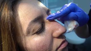 NonSurgical Nose Job NSNJ using Restylane [upl. by Crandall]