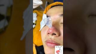 Inflamed Acne on Nose shorts pimple acne acneking [upl. by Seuqramed]