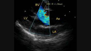 Colour Doppler Echo in Tetralogy of Fallot [upl. by Eneloc]