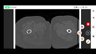 chondrosarcomaRadiology scroll cases series ☢️ [upl. by Ofloda]