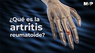 Artritis Reumatoide  ExclusivoMSP [upl. by Dragone]