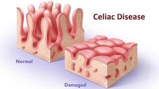 Celiac Disease [upl. by Athal]