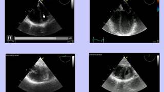 ACUTE COR PULMONALE IN MV PATIENT CAUSES TREATMENTS THERAPIES A VieillardBaron [upl. by Cesar]