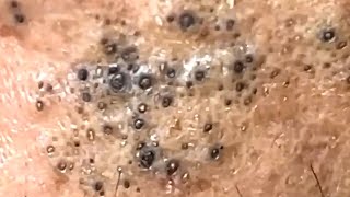 Blackheads Satisfying Removal 0003 [upl. by Oivat]